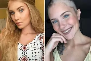 Ibu ini rela lukis kepala putrinya yang botak akibat penyakit langka