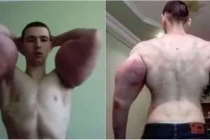 Gara-gara overdosis obat kimia, otot pria ini berubah bak Popeye