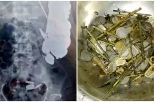 Dikira keracunan, isi perut pria ini ternyata paku dan koin