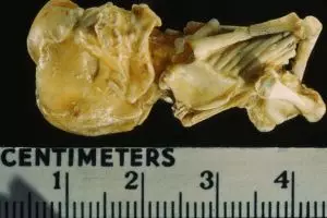 Mengeluh perut sakit, wanita ini ternyata mengandung janin 15 tahun