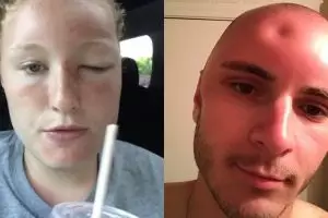 Wajah 4 orang ini bengkak terbakar sinar matahari, ada yang penyok