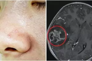 Duh, anak 10 tahun ini derita infeksi otak usai komedonya dipencet