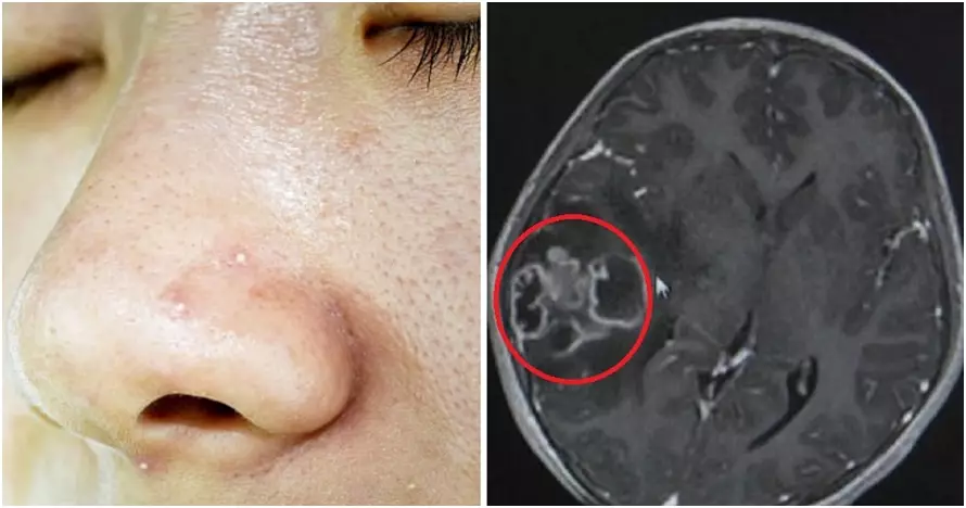 Duh, anak 10 tahun ini derita infeksi otak usai komedonya dipencet