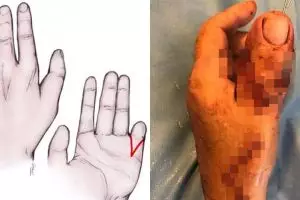 Jempol tangan pria ini diganti jempol kaki setelah kecelakaan