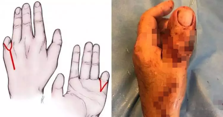 Jempol tangan pria ini diganti jempol kaki setelah kecelakaan