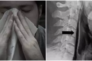 Sering tahan bersin, tenggorokan pria ini akhirnya pecah