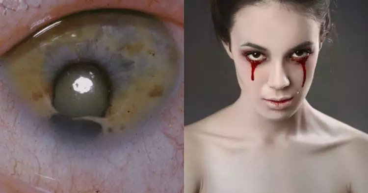 9 Masalah kesehatan mata paling mengerikan