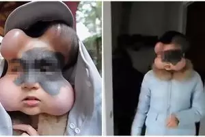 Ada 4 benjolan di wajah wanita ini, fakta di baliknya ngeri banget