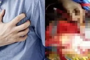 Pria ini hidup dengan dua jantung yang berdetak, kok bisa ya?