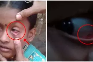 Diduga kena kutuk, mata bocah ini keluarkan 60 ekor semut