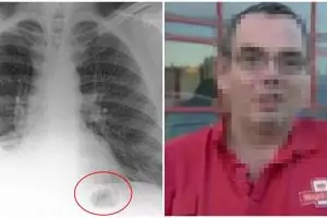 Dikira kanker, ternyata ada lego nyelip 47 tahun di paru-paru pria ini