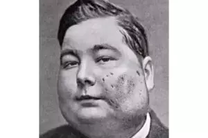 4 Potret mengerikan efek radium yang jadi bahan kecantikan zaman dulu