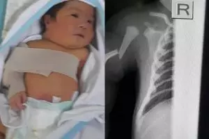 Potret miris bayi baru lahir yang alami patah tulang lengan
