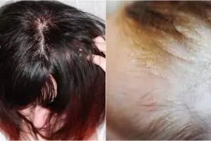 10 Kepala penuh ketombe ini menjijikkan banget, nggak pernah keramas?