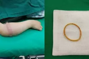 Hanya karena pakai karet gelang, kondisi tangan bocah ini ngeri parah