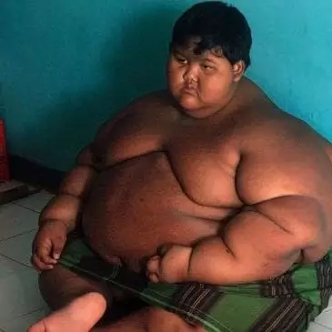 Ingat Arya Permana, bocah berbobot 188 kg? Kondisinya kini bikin kaget