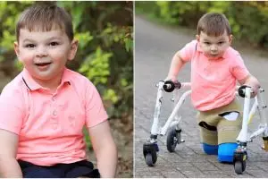 Dianiaya orangtuanya, balita ini dirawat 41 hari dan akhirnya lumpuh