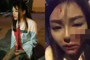 Melawan saat dicopet, wajah wanita ini berakhir mengenaskan