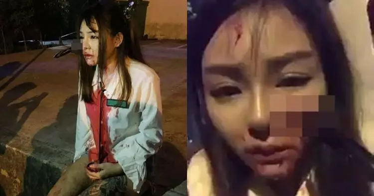 Melawan saat dicopet, wajah wanita ini berakhir mengenaskan