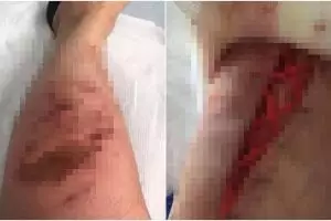 Tak sengaja terkena tumbuhan beracun, kaki pria ini hampir diamputasi