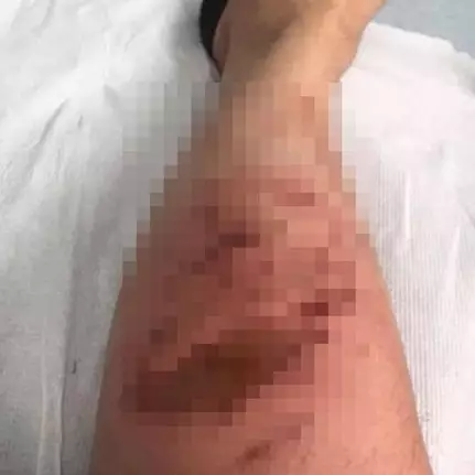 Tak sengaja terkena tumbuhan beracun, kaki pria ini hampir diamputasi