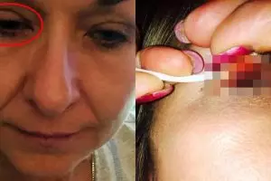 Tak pernah hapus maskara selama 25 tahun, wanita ini nyaris buta