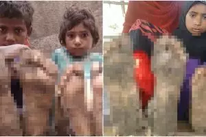 Terkena penyakit langka, kondisi kaki 3 anak ini berubah mengerikan