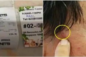 Tergiur harga promo laser tahi lalat, begini nasib pria 52 tahun ini