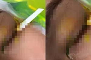 Tergiur harga softlens Rp 70 ribu, kondisi mata wanita ini hampir buta