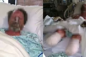 Dijilat anjing peliharaannya, kondisi kaki pria ini berakhir miris