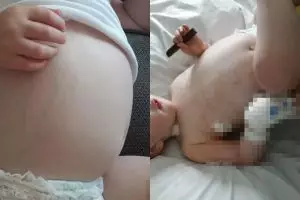 Dikira masuk angin, fakta di balik perut  balita membesar ini ngeri