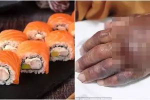 Gara-gara makan sushi, kondisi tangan pria ini berakhir mengerikan