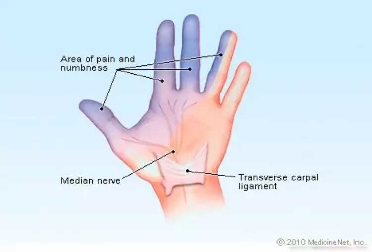 7 Cara cegah sindrom Carpal, sakit nyeri hingga mati rasa pada tangan