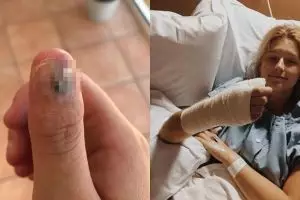 Hobi gigit kuku, jari gadis ini terpaksa diamputasi