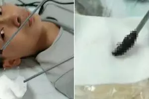 Pria ini mimisan selama 10 hari, penyebabnya benar-benar tak terduga