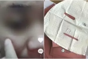 Gara-gara pakai face mask, kondisi wajah wanita ini jadi mengerikan