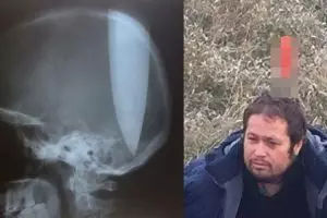 Pria ini tancapkan pisau di kepalanya, alasannya bikin geleng kepala