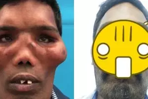 5 Transformasi wajah pengidap lion face usai oplas ini bikin pangling