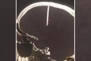 Sakit kepala pria ini tak biasa, penyebabnya bikin bergidik ngeri