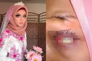 Pakai softlens saat acara pernikahan, nasib pengantin ini tragis