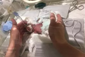Lahir berbobot 268 gram, ini foto terbaru bayi terkecil di dunia