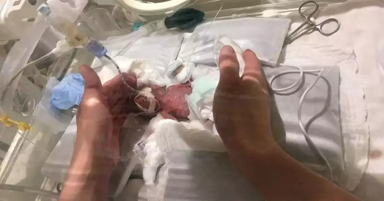 Lahir berbobot 268 gram, ini foto terbaru bayi terkecil di dunia