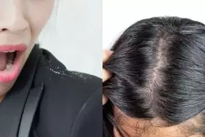 12 Cara menghilangkan ketombe secara alami dan mudah