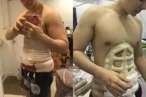 Heboh operasi perut six pack, 8 potret prosesnya bikin ngilu