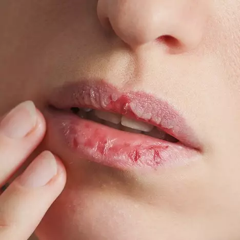 8 Cara mencegah bibir kering selama puasa, mudah &amp; praktis