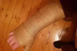 Pria patah tulang bikin perban bak tangan Thanos, ini 10 fotonya