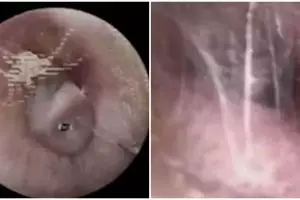 Laba-laba yang memintal jaring dalam telinga pria ini bikin ngeri