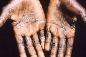 5 Fakta cacar monyet, penyakit langka yang ditemukan di Singapura