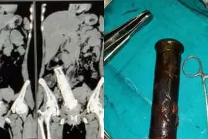 Akibat KDRT, stang motor tertinggal dua tahun di rahim wanita ini