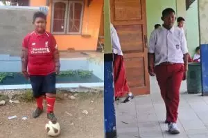 Bocah obesitas Arya Permana bakal jalani operasi plastik
